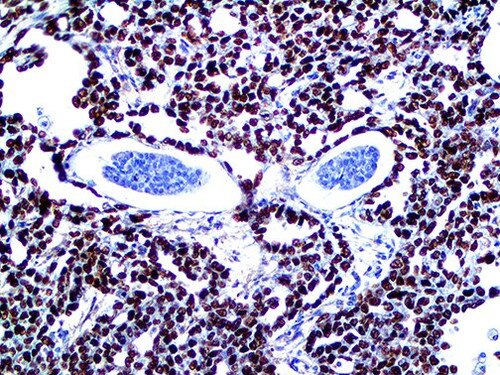 IHC of SALL4 on an FFPE Testicular Cancer Metastasis to Liver Tissue